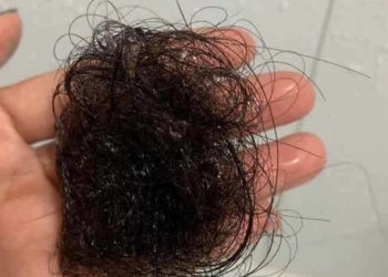 Rụng tóc thiếu chất gì? Top 7 nguyên nhân khiến tóc rụng
